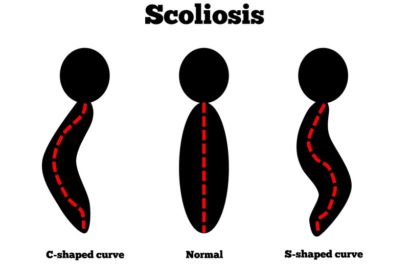 Calcutta, OH scoliosis treatment